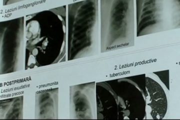 Pacienţii cu tuberculoză trataţi în ambulatoriu vor beneficia de o indemnizaţie lunară de hrană, anunță Ministerul Sănătății