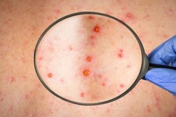 UPDATE Al doilea caz de variola maimuței, confirmat în România: un bărbat de 32 de ani din Capitală. MS: Nu există o legătură între cele două cazuri confirmate