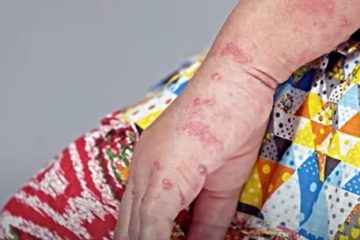 Un nou caz de variola maimuței a fost confirmat în România. Numărul pacienților infectați a ajuns la 19