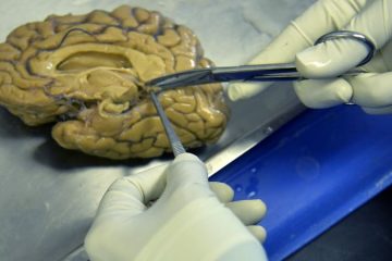 Omul care a sfidat genetica timp de zeci de ani poate avea un indiciu pentru prevenirea bolii Alzheimer, spun oamenii de știință – CNN