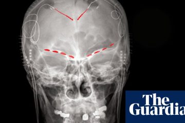 Oamenii de știință descoperă semnale cerebrale pentru durerea cronică – The Guardian