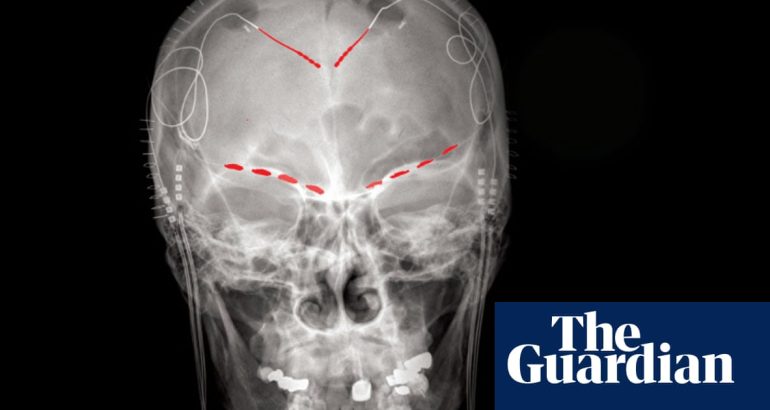 oamenii-de-stiinta-descopera-semnale-cerebrale-pentru-durerea-cronica-–-the-guardian