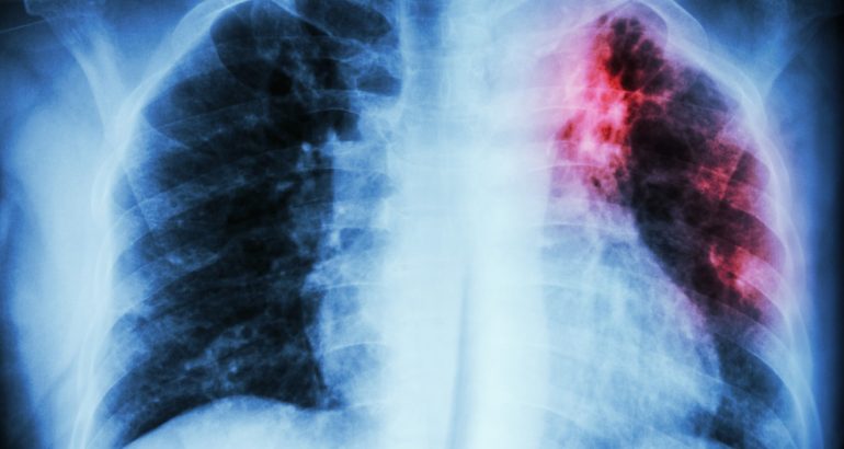 more-than-500-children-exposed,-tested-for-tuberculosis-in-nebraska-–-the-washington-post