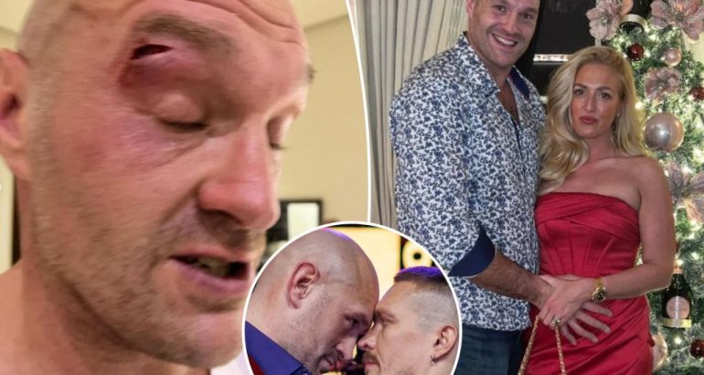 tyson-fury’s-wife-left-‘shaking’-by-gruesome-cut-that-postponed-oleksandr-usyk-bout-–-new-york-post