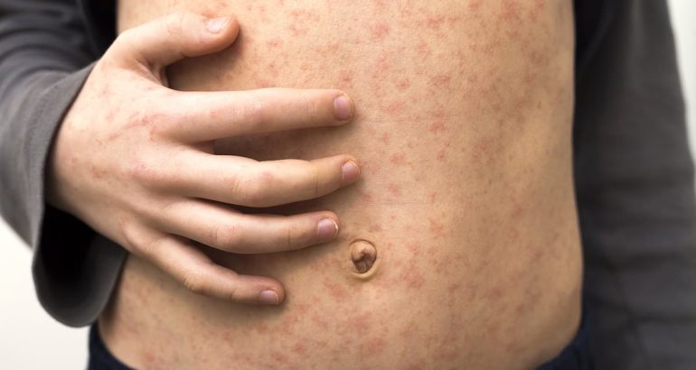 florida-becomes-the-new-epicenter-of-measles-outbreak-–-daily-mail