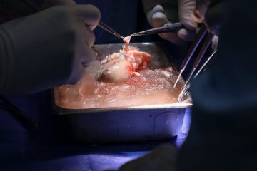 Patient With Transplanted Pig Kidney Leaves Hospital for Home – The New York Times
